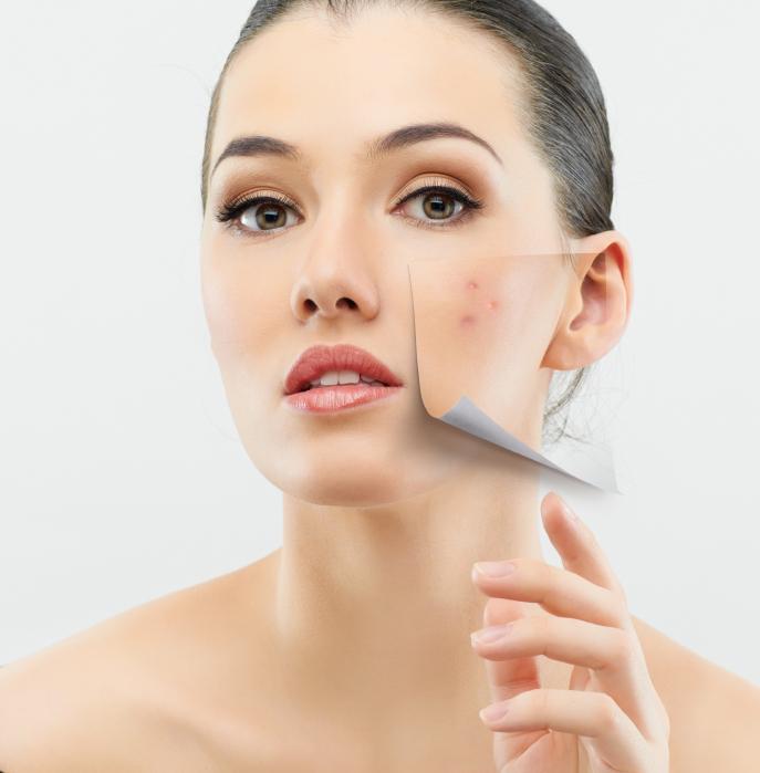 Como usar el aloe vera para el acne