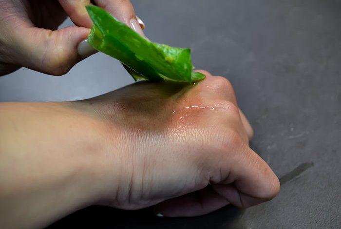 Aloe vera para quemaduras de agua hirviendo