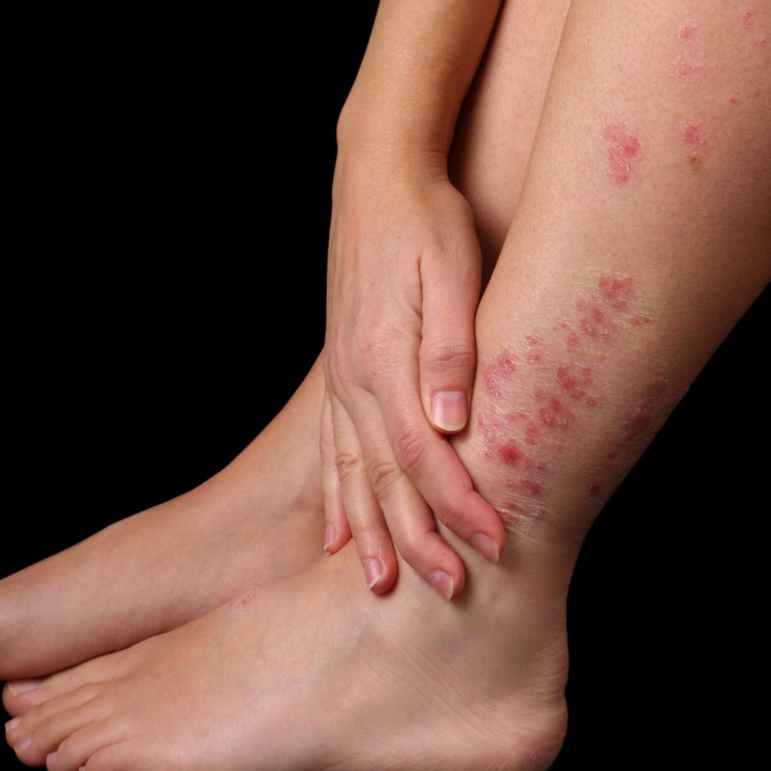 Tratar psoriasis con aloe vera