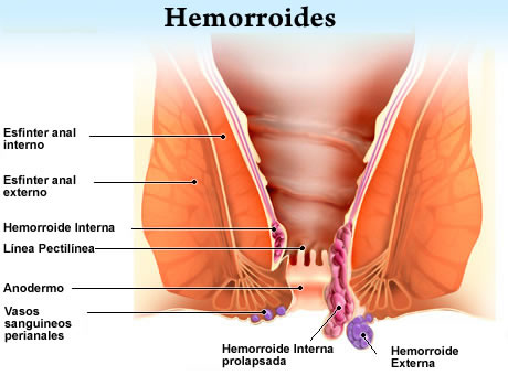 Aloe vera para hemorroides sangrantes