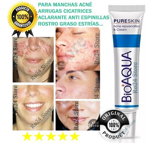 Aloe vera para cicatrices de acne