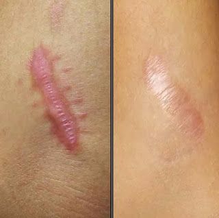 Como aplicar aloe vera en cicatrices