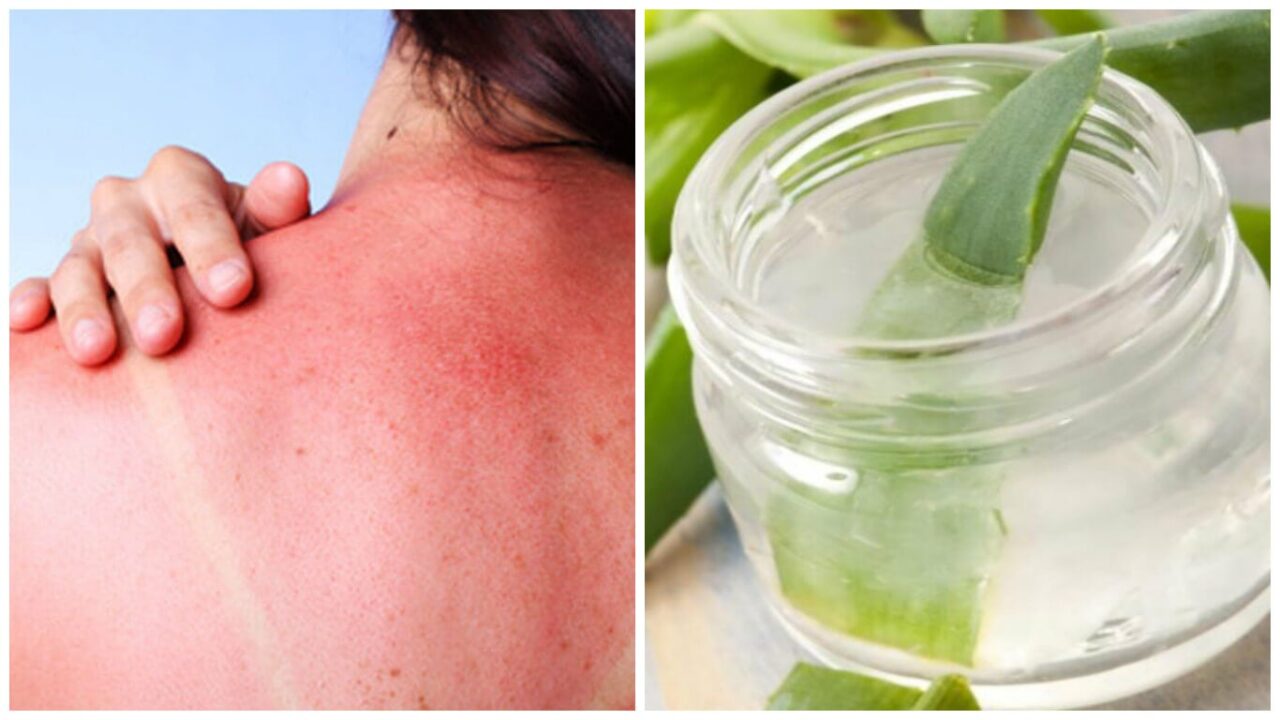 Crema aloe vera para quemaduras sol