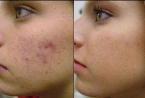 Como usar la planta de aloe vera para el acne