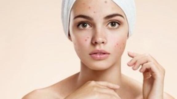 Mascarilla de aloe vera para cicatrices de acne