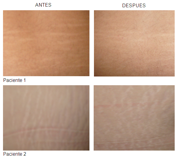 Aceite de aloe vera para estrias