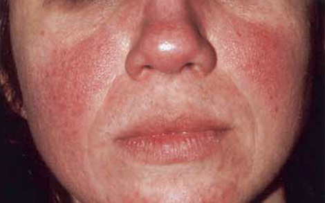 Aloe vera para la piel rosacea