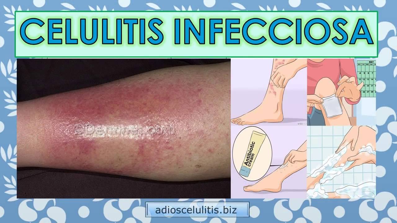 Aloe vera para celulitis infecciosa