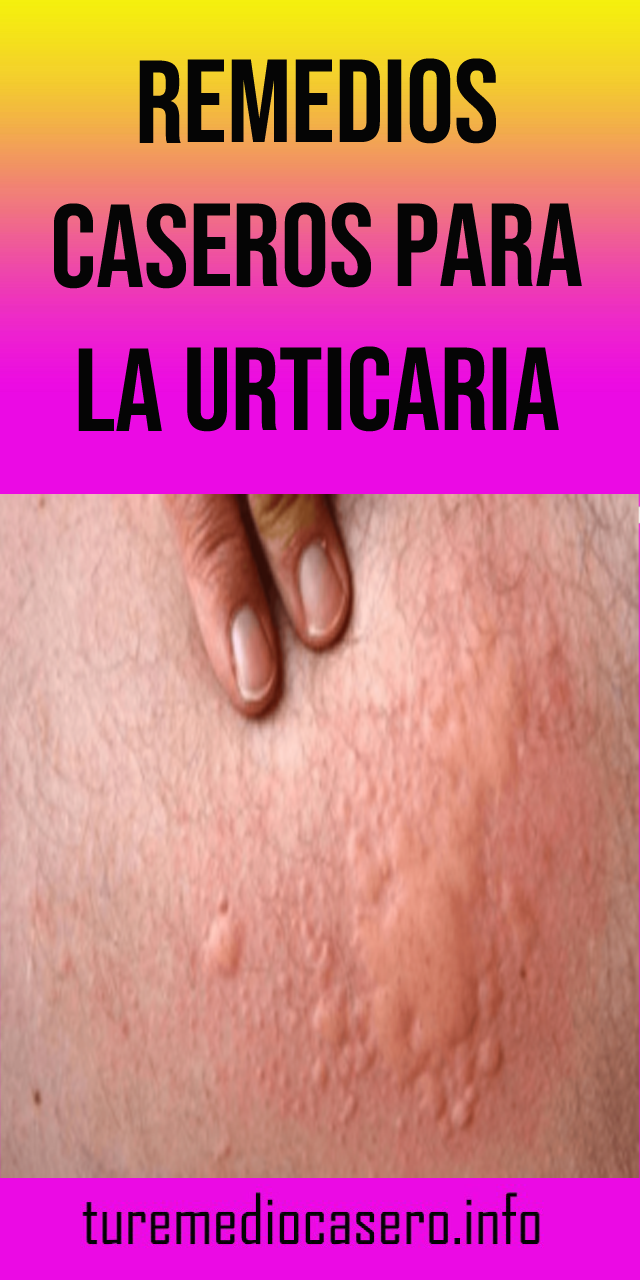 Aloe vera para urticaria